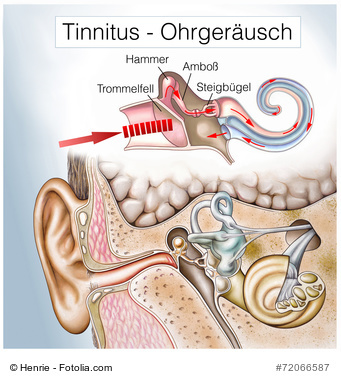 Tinnitus (Ohrensausen)