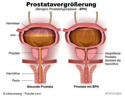 vergrößerte prostata medikamente test)