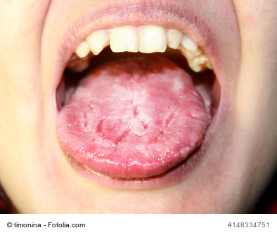 Mund-Soor - Befall der Zunge