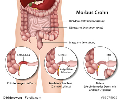 Symptome bei Morbus Crohn