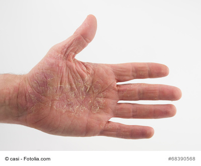 Neurodermitis der Handinnenfläche