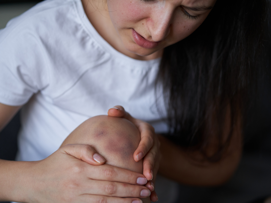 Frau mit Hämatom am Knie