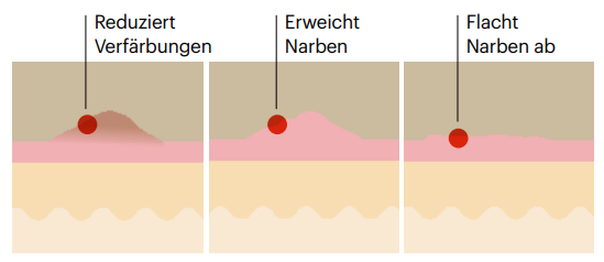 pds_16240611_Narben.png